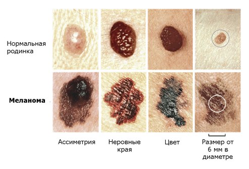 Лечение рака кожи